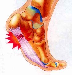 artrózis és a vállízület csontritkulása az időleges ízületek gyulladása